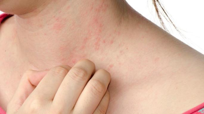 The Risky Causes and Factors of Psoriasis